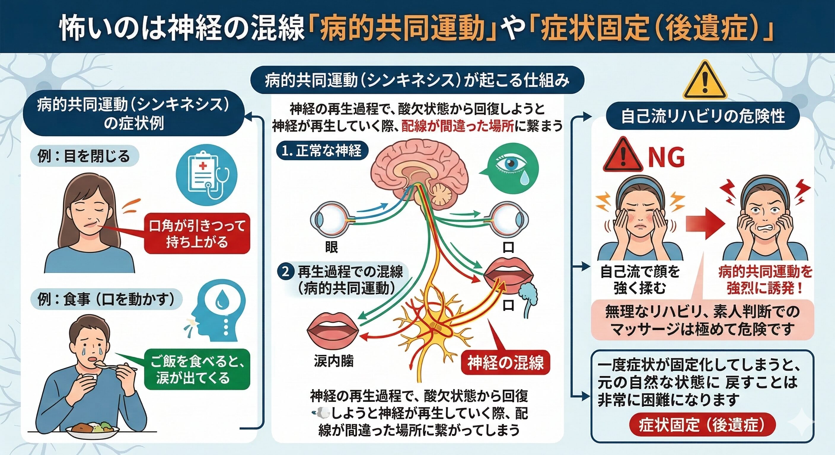 顔面神経麻痺の後遺症「病的共同運動(シンキネシス)」の仕組みと自己流リハビリの危険性を解説した図
